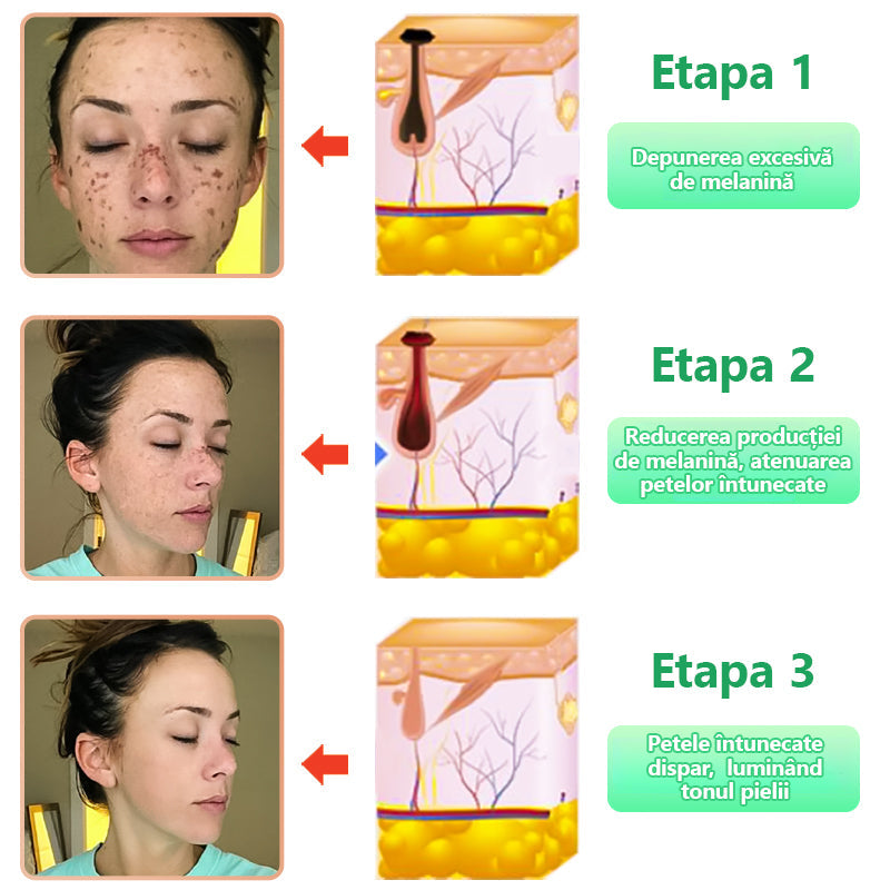 Gel exfoliant purificator pentru Acanthosis Nigricans, exfoliere, pete întunecate, etichete cutanate și eczeme x💖💖