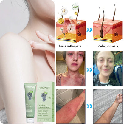 Gel exfoliant purificator pentru Acanthosis Nigricans, exfoliere, pete întunecate, etichete cutanate și eczeme x💖💖