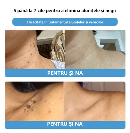 👑 👑 👑 👑 [ Magazin oficial al mărcii] Lenaro™ Venin de Albine Venin de Albine Cremă Pentru Tratarea Alunițelor și Negilor(👨‍⚕EADV RECOMANDĂ)