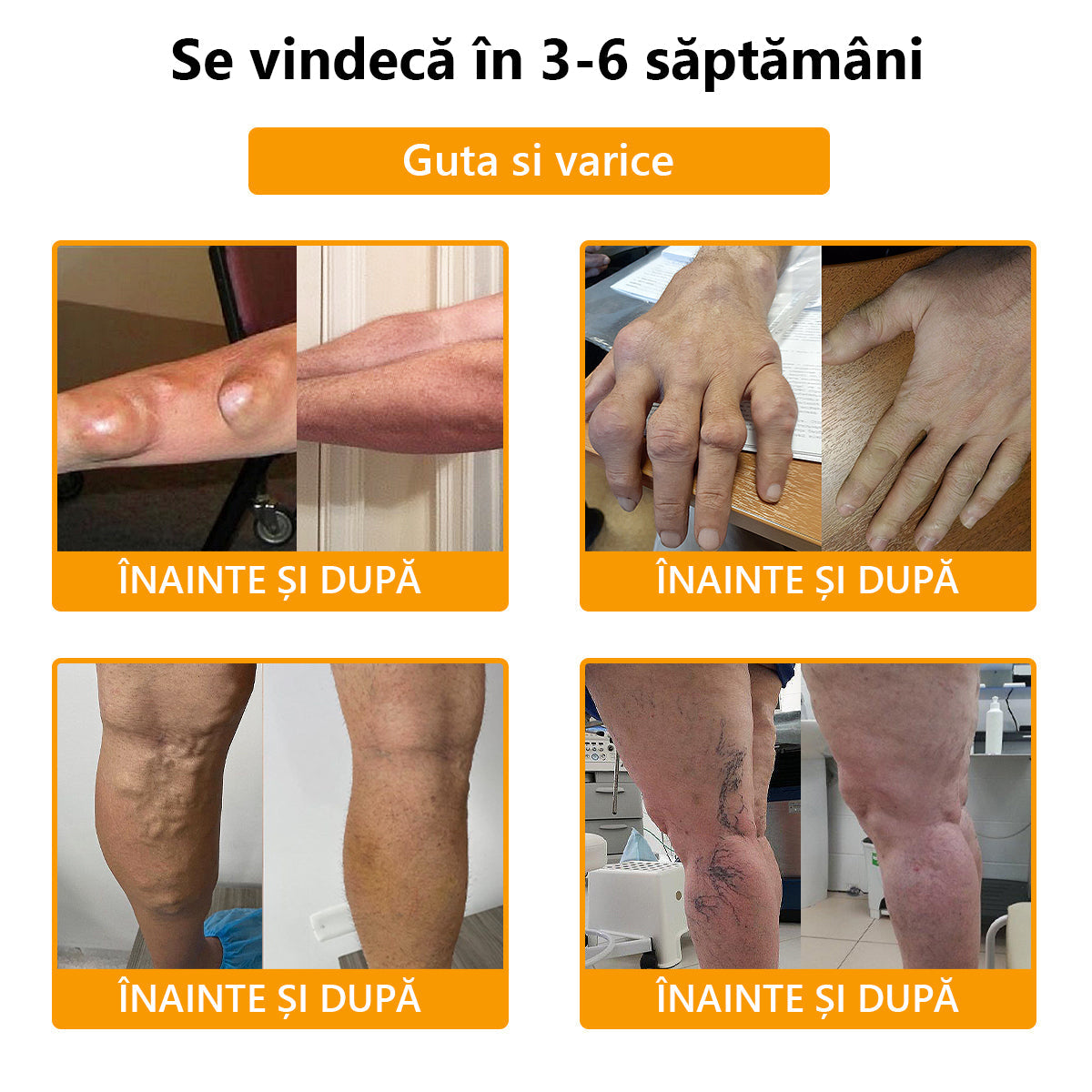 🍀🍀ArthroFree™ Cremă pentru dureri osoase cu venin de albine🐝(În special pentru adulții în vârstă și recomandat de AAOS) x