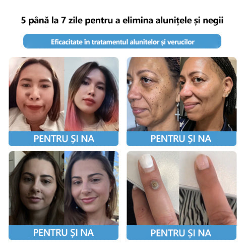 👑 👑 👑 👑 [ Magazin oficial al mărcii] Lenaro™ Venin de Albine Venin de Albine Cremă Pentru Tratarea Alunițelor și Negilor(👨‍⚕EADV RECOMANDĂ)