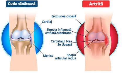 🍀🍀ArthroFree™ Cremă pentru dureri osoase cu venin de albine🐝(În special pentru adulții în vârstă și recomandat de AAOS) x