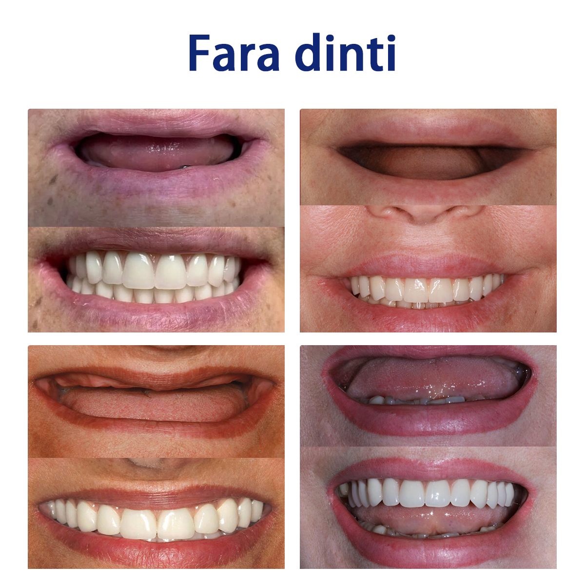 𝐵𝑖𝑘𝑒𝑛𝑑𝑎™ Set de Regle Dentare din Silicon 🧨🧨 (👩‍🔬Conform cu CED, Aprobat de Stomatologi Profesioniști)