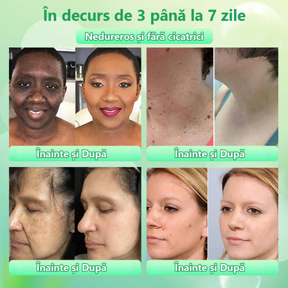 Gel exfoliant purificator pentru Acanthosis Nigricans, exfoliere, pete întunecate, etichete cutanate și eczeme x💖💖