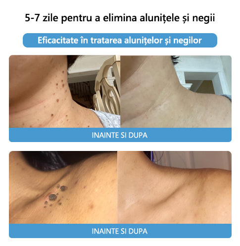 🎉🎉🎉[✨ Magazin Oficial Al Mărcii✨] Lenaro™ Venin de albine Venin de albine Cremă pentru tratarea alunițelor și negilor(👨‍⚕AAD RECOMANDĂ)