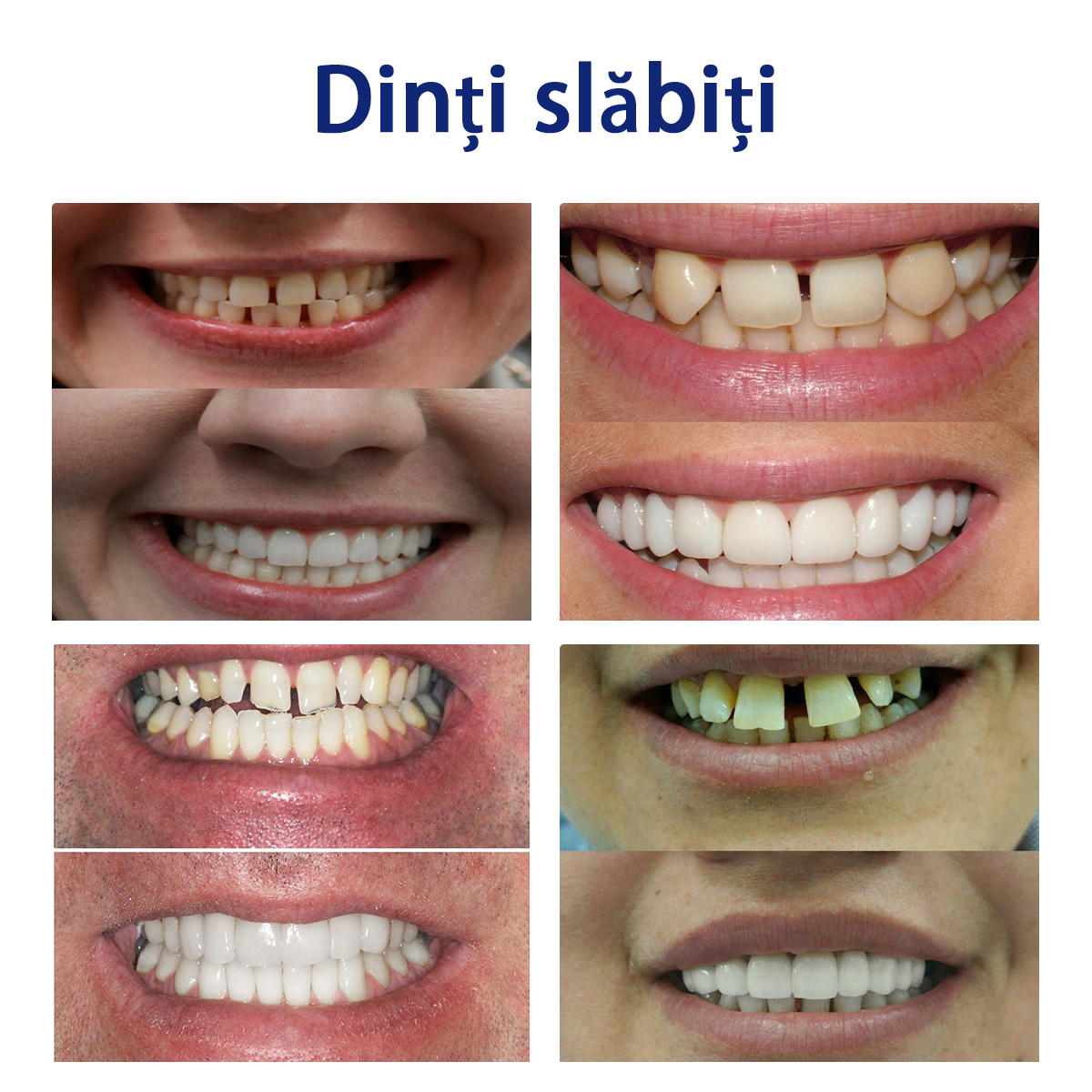 𝐵𝑖𝑘𝑒𝑛𝑑𝑎™ Set de Regle Dentare din Silicon 🧨🧨 (👩‍🔬Conform cu CED, Aprobat de Stomatologi Profesioniști)