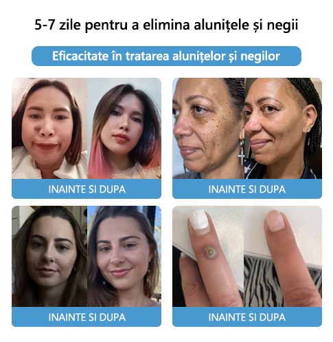 🌈🌈🧴🧴[👑Magazinul oficial al mărcii👑] LEFUN™ Cremă pentru tratamentul alunițelor și negilor cu venin de albine ( 👨 ⚕AAD RECOMANDAT)