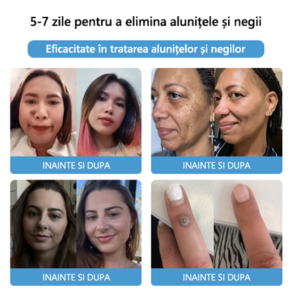 🌈🌈🧴🧴[👑Magazinul oficial al mărcii👑] LEFUN™ Cremă pentru tratamentul alunițelor și negilor cu venin de albine ( 👨 ⚕AAD RECOMANDAT)