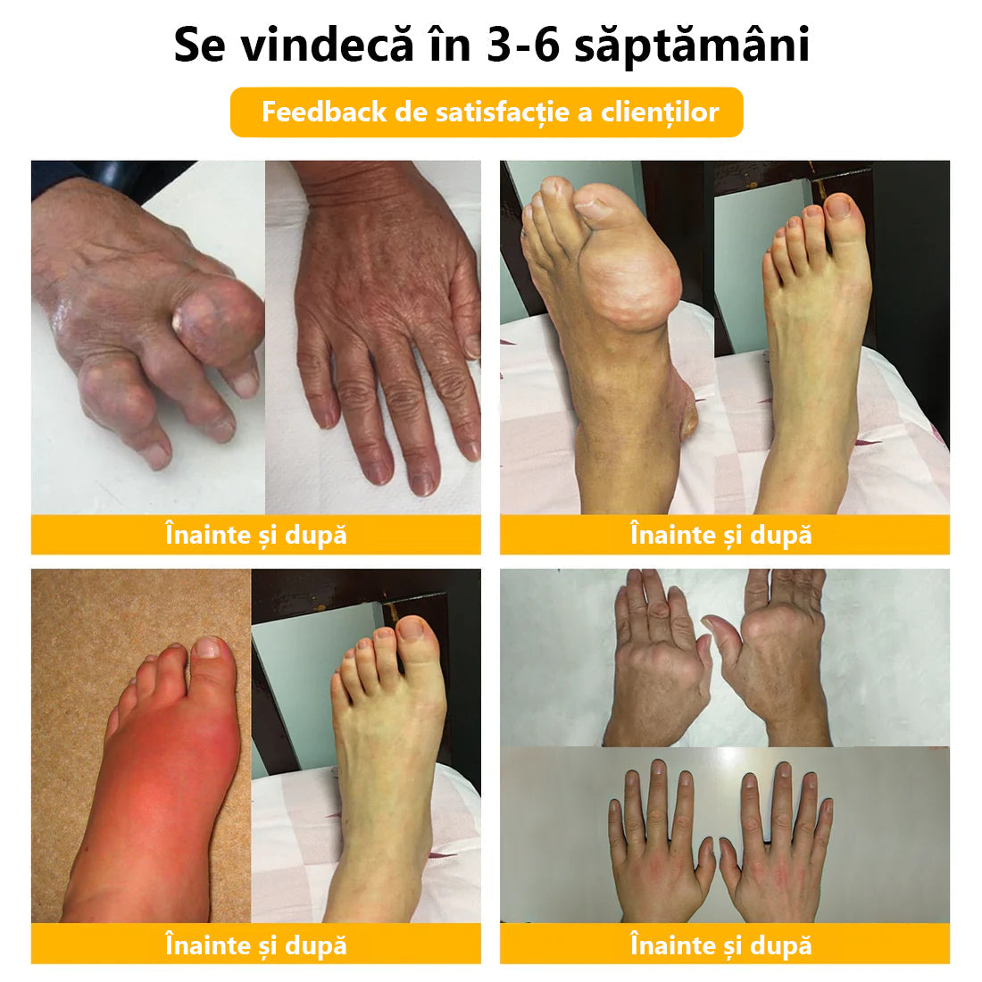 🍀🍀ArthroFree™ Cremă pentru dureri osoase cu venin de albine🐝(În special pentru adulții în vârstă și recomandat de AAOS) x