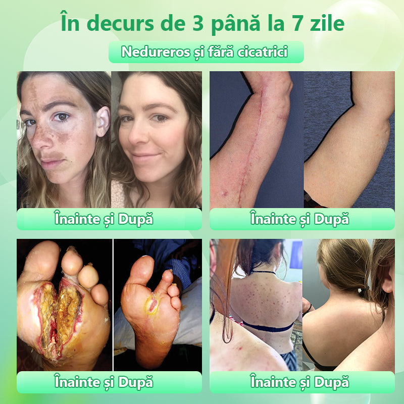 Gel exfoliant purificator pentru Acanthosis Nigricans, exfoliere, pete întunecate, etichete cutanate și eczeme x💖💖