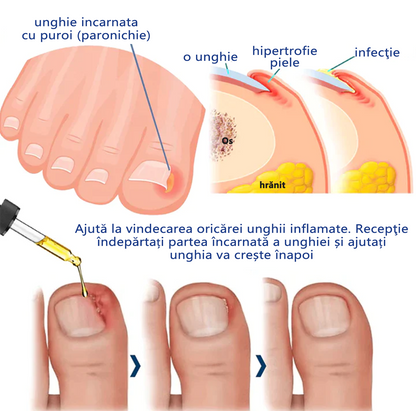 🔥🔥Ulei german ToenaCare™ îndepărtarea Paronychia🔥(Reducere limitată de timp durează 30 de minute) lmny