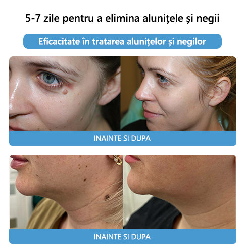 🎉🎉🎉[✨ Magazin Oficial Al Mărcii✨] Lenaro™ Venin de albine Venin de albine Cremă pentru tratarea alunițelor și negilor(👨‍⚕AAD RECOMANDĂ)