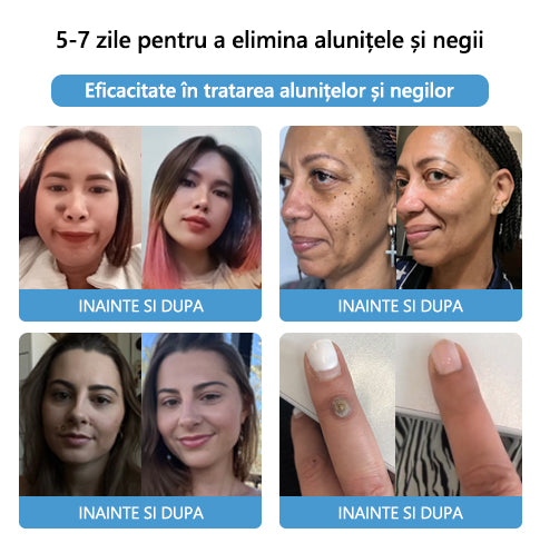 🎉🎉🎉[✨ Magazin Oficial Al Mărcii✨] Lenaro™ Venin de albine Venin de albine Cremă pentru tratarea alunițelor și negilor(👨‍⚕AAD RECOMANDĂ)