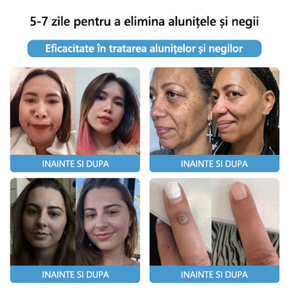 [👑Magazinul oficial al mărcii👑] LEFUN™ Cremă cu venin de albine pentru tratarea alunițelor și verucilor(👨‍⚕AAD RECOMANDĂ)4